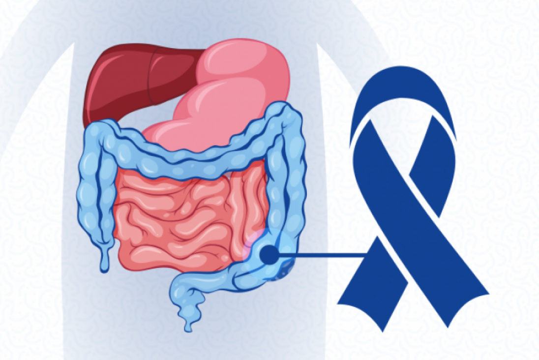 imagen "Si te controlás, lo prevenís": la UNCuyo concientiza sobre el cáncer de colon